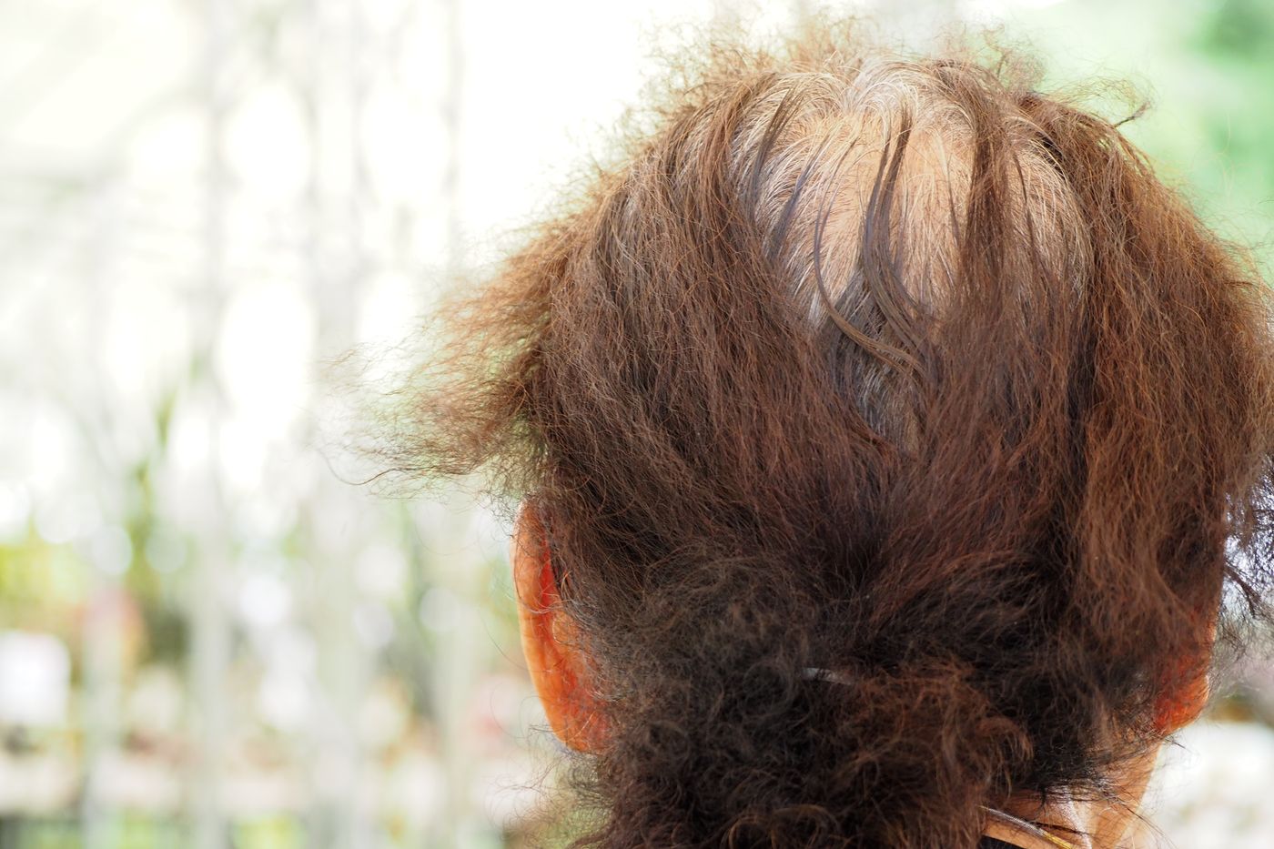 Alopecia hair regrowth study