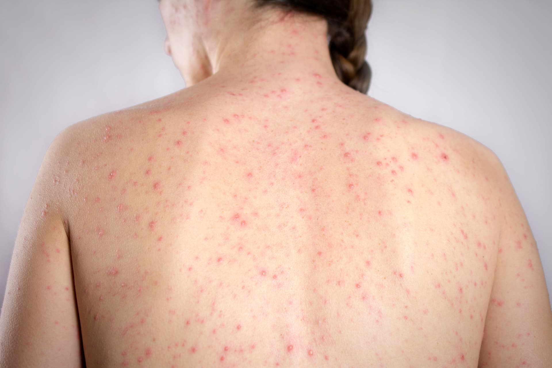 Close-up of measles rash on skin