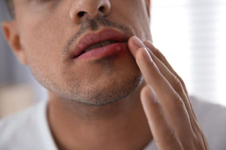New Discovery Could Lead to Breakthrough in Preventing Cold Sores