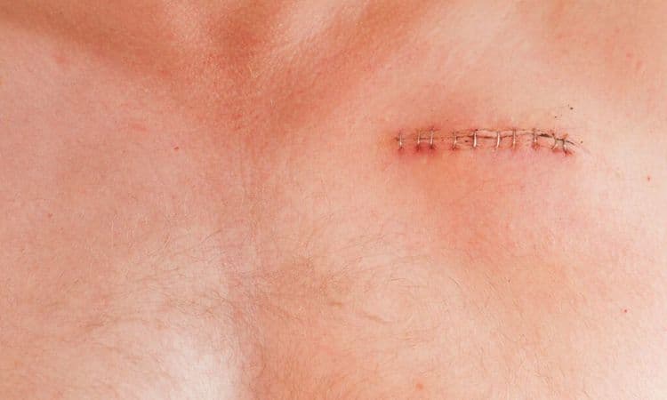 Tiny Light-Activated Device Dissolves After Healing the Heart