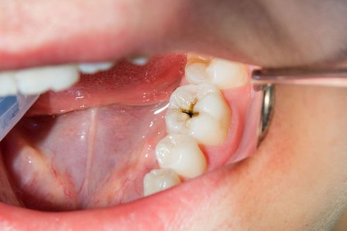 New Liquid Stops Cavities Without Need For Drilling