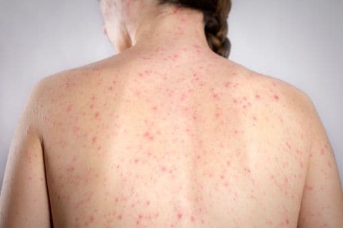 The Largest Measles Outbreak The US Has Seen In 35 Years Has Ended